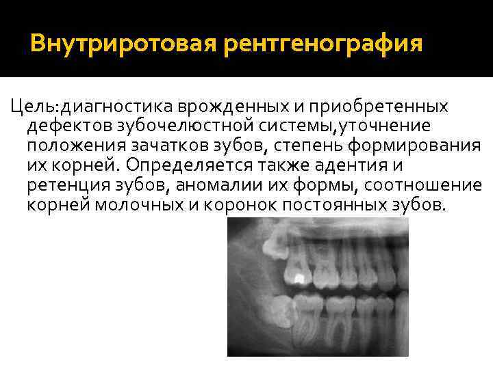 Внутриротовая рентгенография Цель: диагностика врожденных и приобретенных дефектов зубочелюстной системы, уточнение положения зачатков зубов,