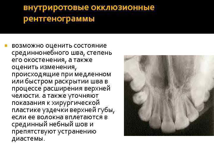 внутриротовые окклюзионные рентгенограммы возможно оценить состояние срединнонебного шва, степень его окостенения, а также оценить