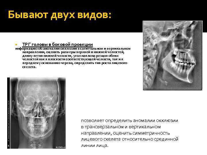 Бывают двух видов: ТРГ головы в боковой проекции информацию об аномалии окклюзии в сагиттальном