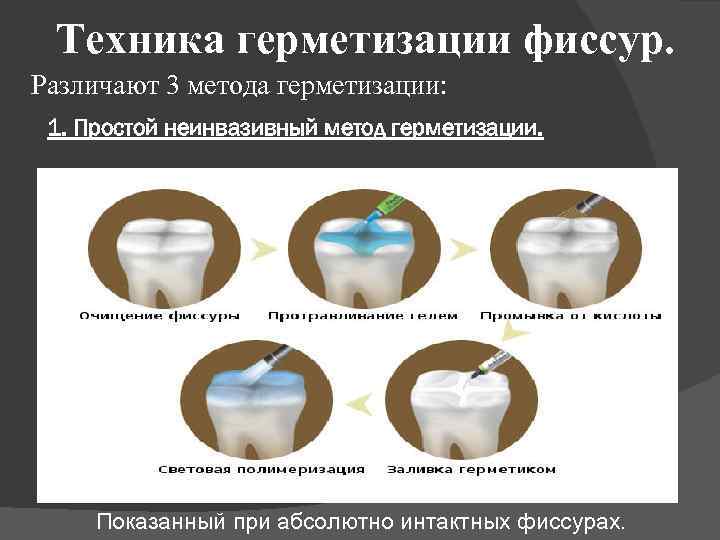 Техника герметизации фиссур. Различают 3 метода герметизации: 1. Простой неинвазивный метод герметизации. Показанный при