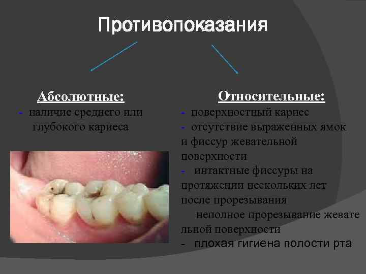 Противопоказания Абсолютные: Относительные: - наличие среднего или глубокого кариеса - поверхностный кариес - отсутствие