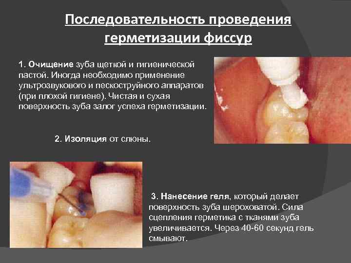 Последовательность проведения герметизации фиссур 1. Очищение зуба щеткой и гигиенической пастой. Иногда необходимо применение