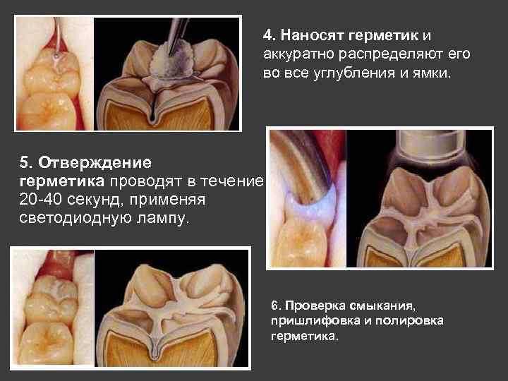 4. Наносят герметик и аккуратно распределяют его во все углубления и ямки. 5. Отверждение