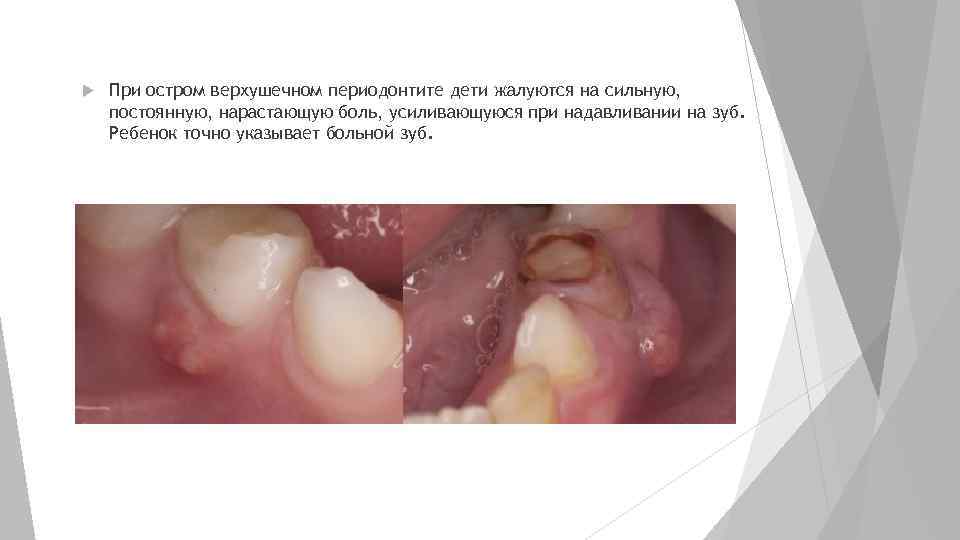  При остром верхушечном периодонтите дети жалуются на сильную, постоянную, нарастающую боль, усиливающуюся при