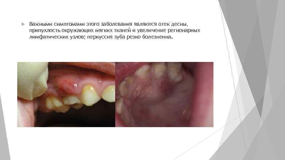  Важными симптомами этого заболевания являются отек десны, припухлость окружающих мягких тканей и увеличение
