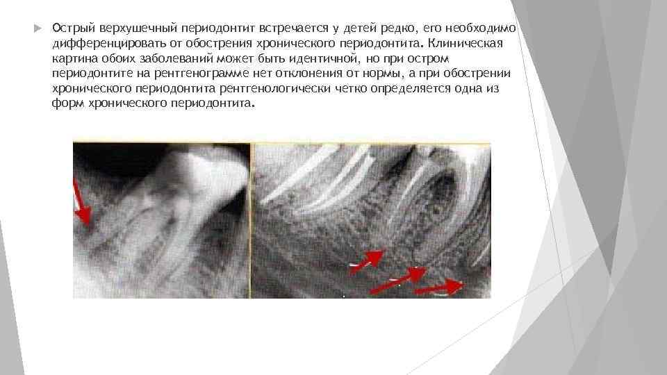  Острый верхушечный периодонтит встречается у детей редко, его необходимо дифференцировать от обострения хронического