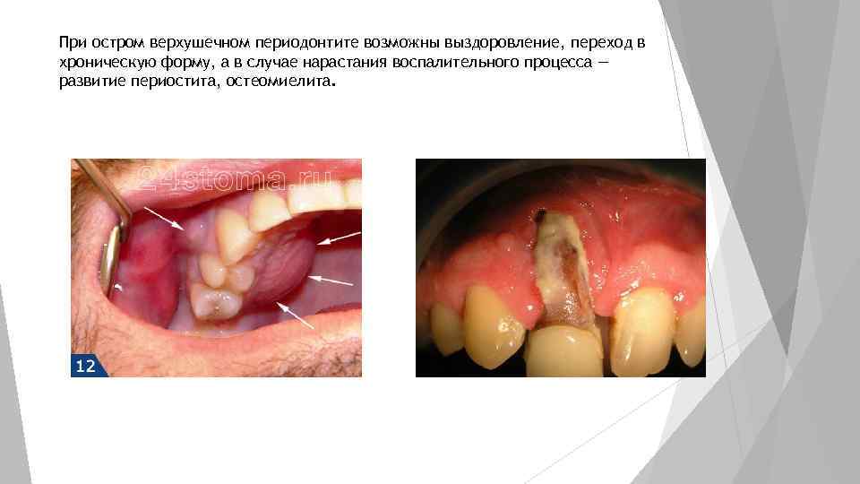 При остром верхушечном периодонтите возможны выздоровление, переход в хроническую форму, а в случае нарастания