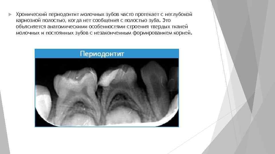 Периодонтит молочного зуба фото