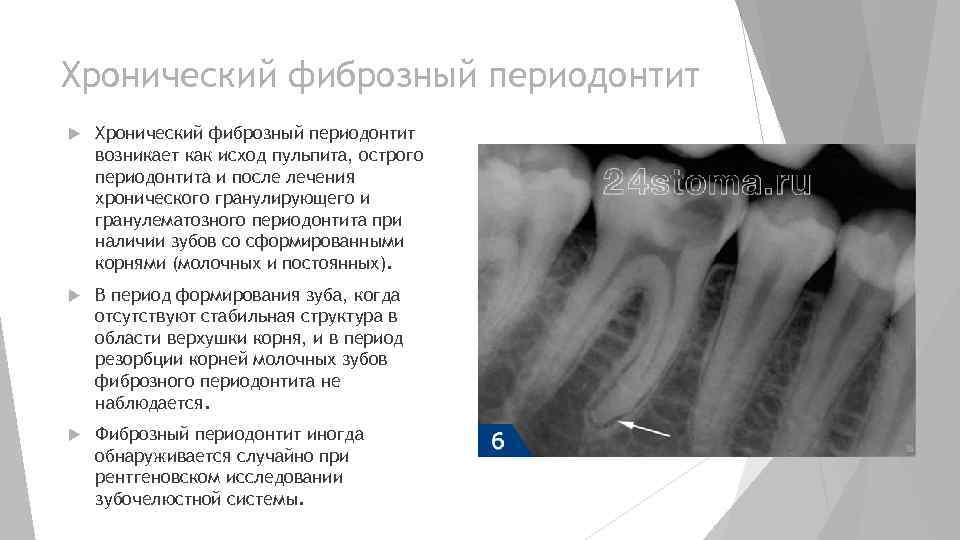 Хронический фиброзный периодонтит возникает как исход пульпита, острого периодонтита и после лечения хронического гранулирующего