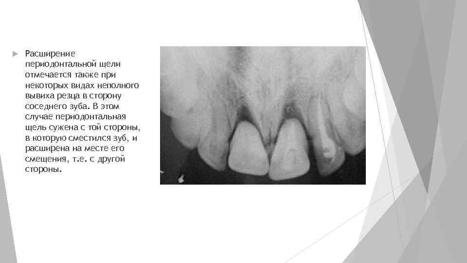  Расширение периодонтальной щели отмечается также при некоторых видах неполного вывиха резца в сторону