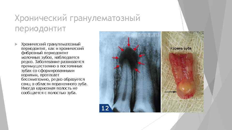 Хронический гранулематозный периодонтит Хронический гранулематозный периодонтит, как и хронический фиброзный периодонтит молочных зубов, наблюдается