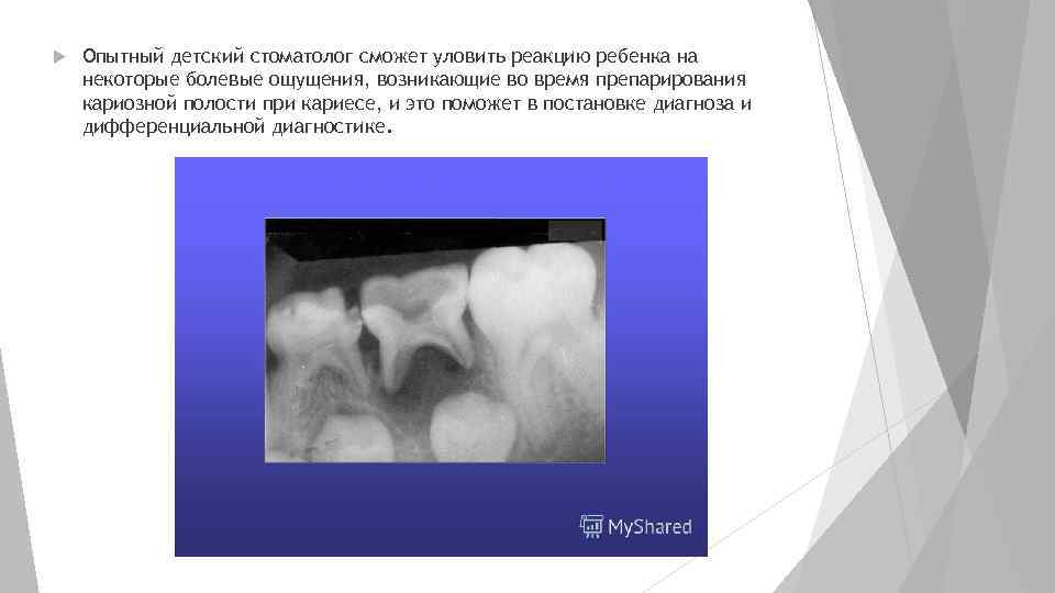  Опытный детский стоматолог сможет уловить реакцию ребенка на некоторые болевые ощущения, возникающие во