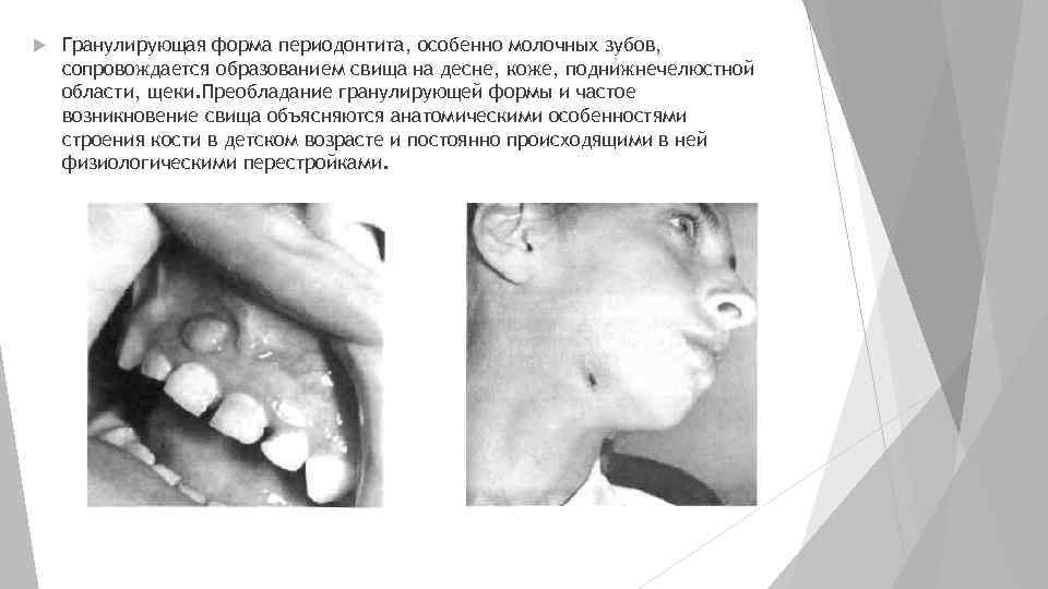  Гранулирующая форма периодонтита, особенно молочных зубов, сопровождается образованием свища на десне, коже, поднижнечелюстной