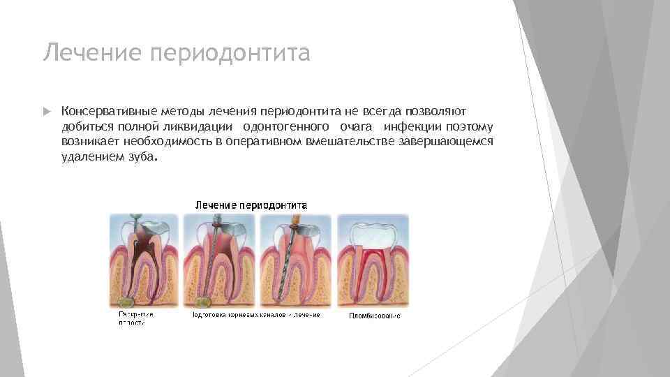 Лечение периодонтита Томск Боровая Удаление молочного зуба Томск Бакунина
