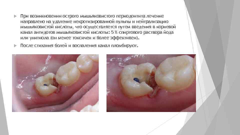  При возникновении острого мышьяковистого периодонтита лечение направлено на удаление некротизированной пульпы и нейтрализацию