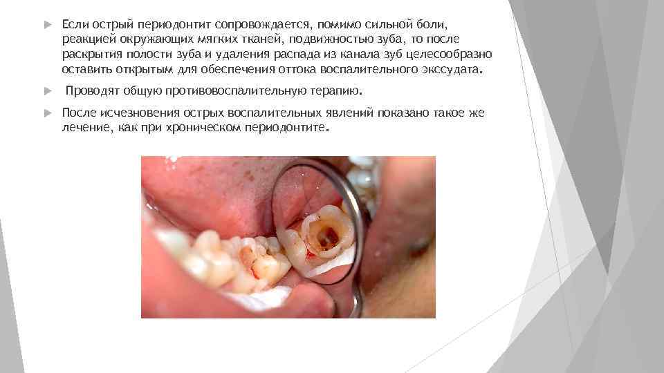  Если острый периодонтит сопровождается, помимо сильной боли, реакцией окружающих мягких тканей, подвижностью зуба,