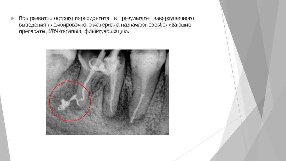  При развитии острого периодонтита в результате заверхушечного выведения пломбировочного материала назначают обезболивающие препараты,