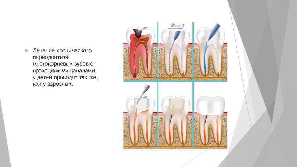Периодонтит лечение. Пульпит многокорневого зуба. Острый периодонтит молочных зубов. Фиброзный периодонтит молочных зубов. Классификация кариес пульпит периодонтит.