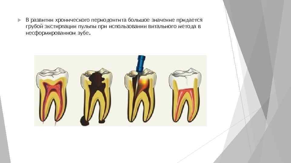 Методы лечения периодонтита презентация