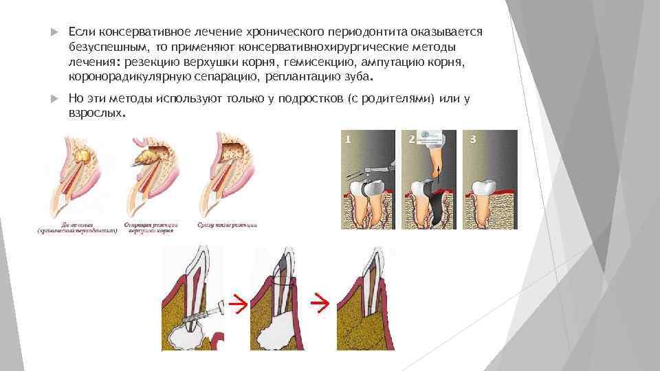 Методы лечения периодонтита презентация