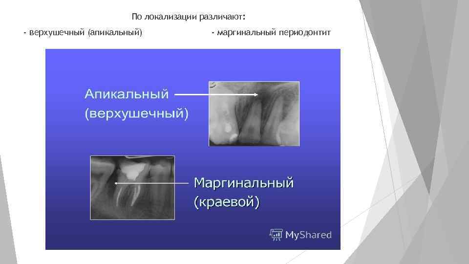 По локализации различают: - верхушечный (апикальный) - маргинальный периодонтит 