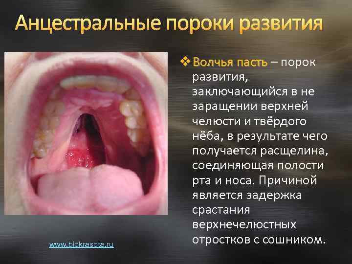 Анцестральные пороки развития www. biokrasota. ru v Волчья пасть – порок пасть развития, заключающийся