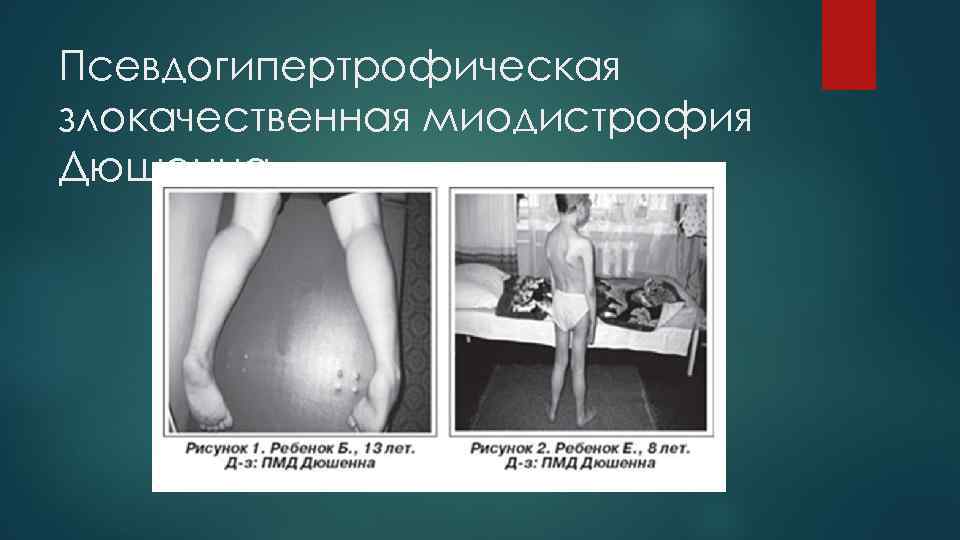 Псевдогипертрофическая злокачественная миодистрофия Дюшенна 