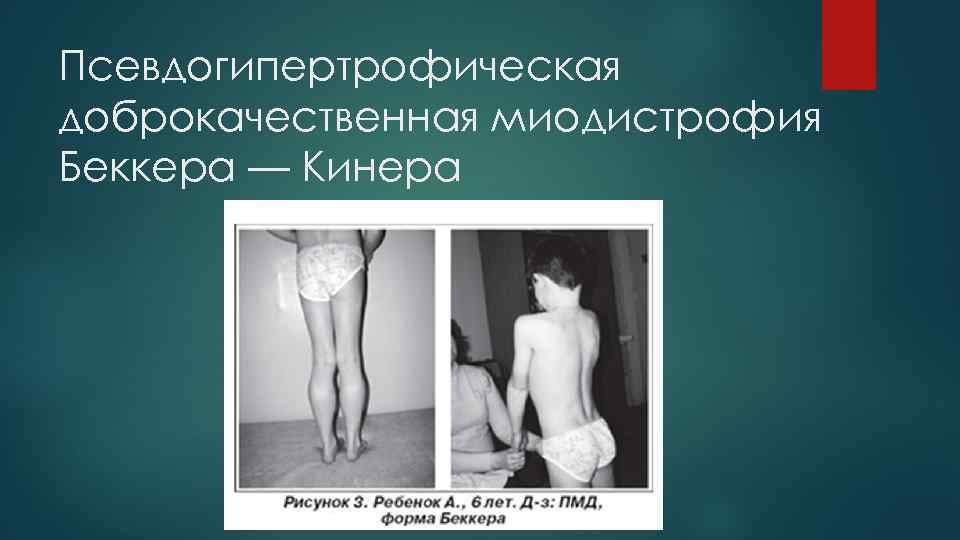 Псевдогипертрофическая доброкачественная миодистрофия Беккера — Кинера 