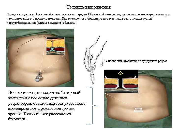 Техника выполнения Толщина подкожной жировой клетчатки и вес передней брюшной стенки создает значительные трудности