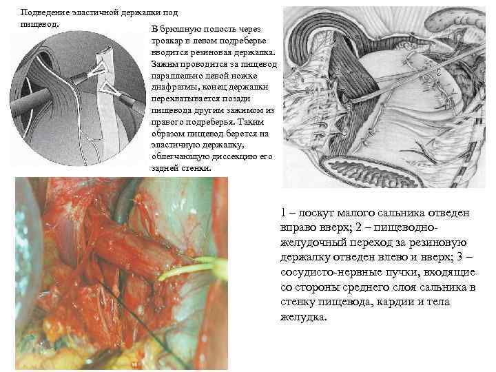 Подведение эластичной держалки под пищевод. В брюшную полость через троакар в левом подреберье вводится