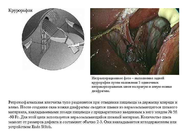 Крурорафия Интраоперационное фото – выполнение задней крурорафии путем наложения 3 одиночных интракорпоральных швов на