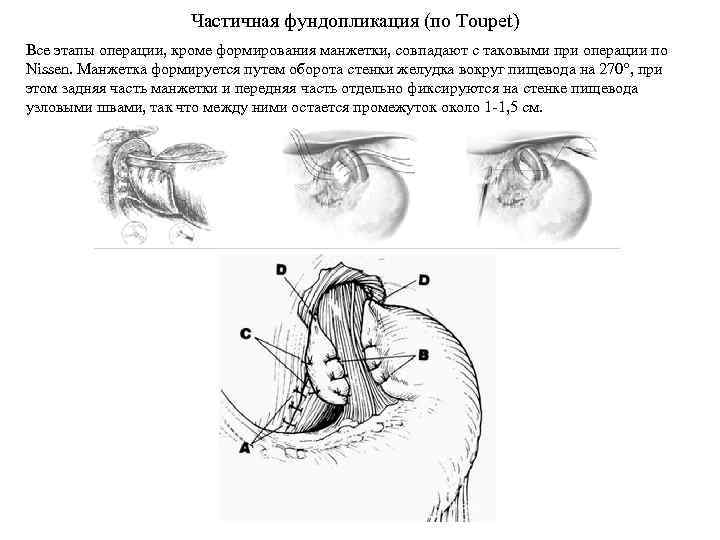 Частичная фундопликация (по Toupet) Все этапы операции, кроме формирования манжетки, совпадают с таковыми при