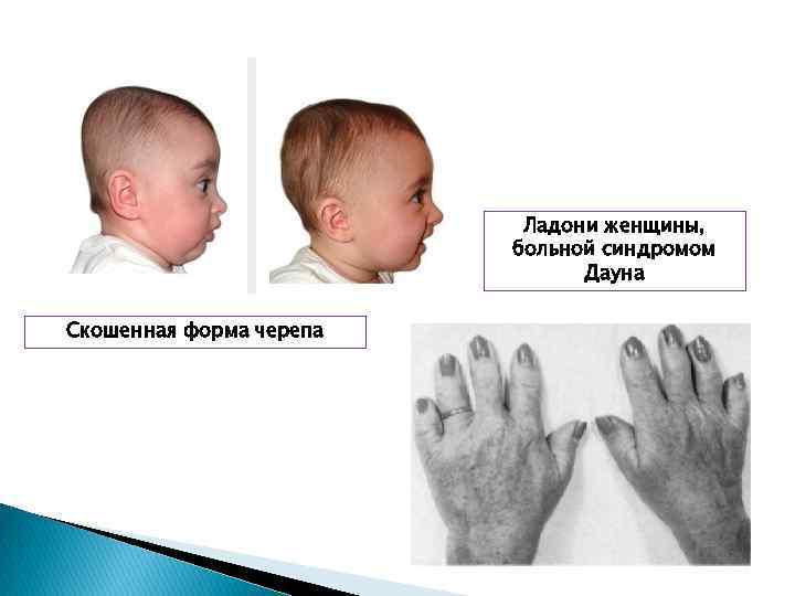 Фенотип ребенка с синдромом дауна. Новорожденные дети с синдромом Дауна. Новорожденные с синдромом Дауна. Форма головы у детей с синдромом Дауна. Синдром Дауна у новорожденных.