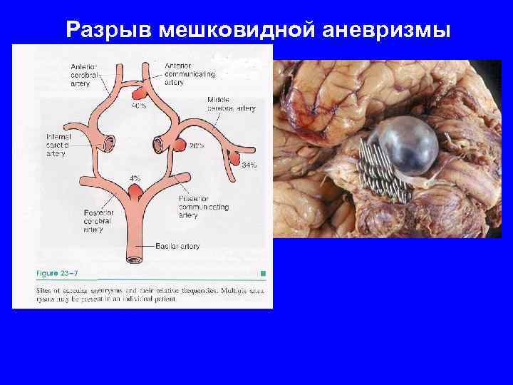 Разрыв мешковидной аневризмы 