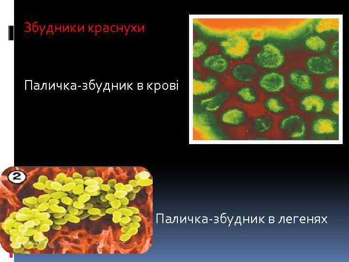 Збудники краснухи Паличка-збудник в крові Паличка-збудник в легенях 