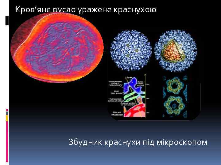 Кров’яне русло уражене краснухою Збудник краснухи під мікроскопом 