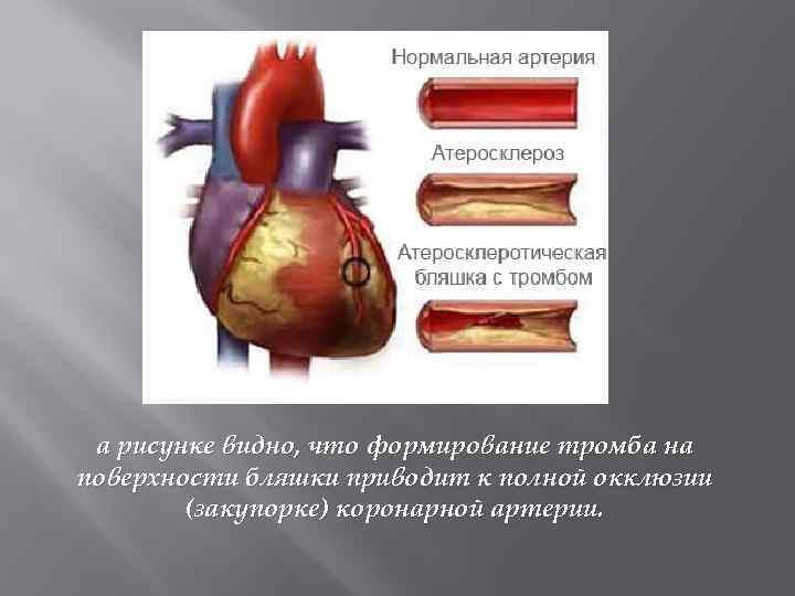 а рисунке видно, что формирование тромба на поверхности бляшки приводит к полной окклюзии (закупорке)