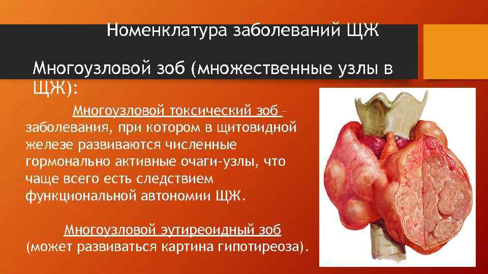 Номенклатура заболеваний ЩЖ Многоузловой зоб (множественные узлы в ЩЖ): Многоузловой токсический зоб – заболевания,