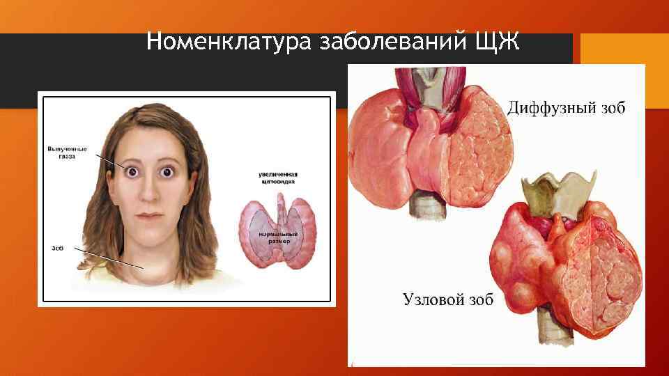 Номенклатура заболеваний ЩЖ 