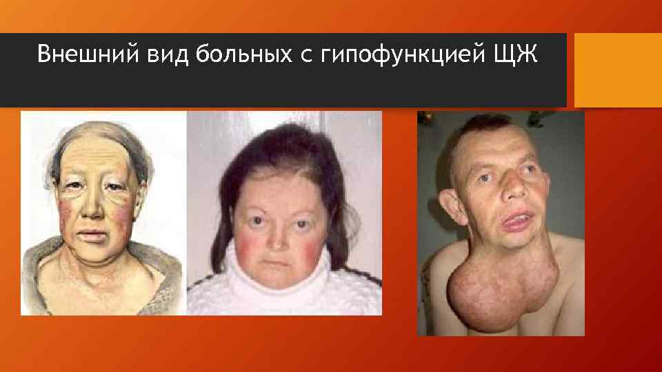 Внешний вид больных с гипофункцией ЩЖ 