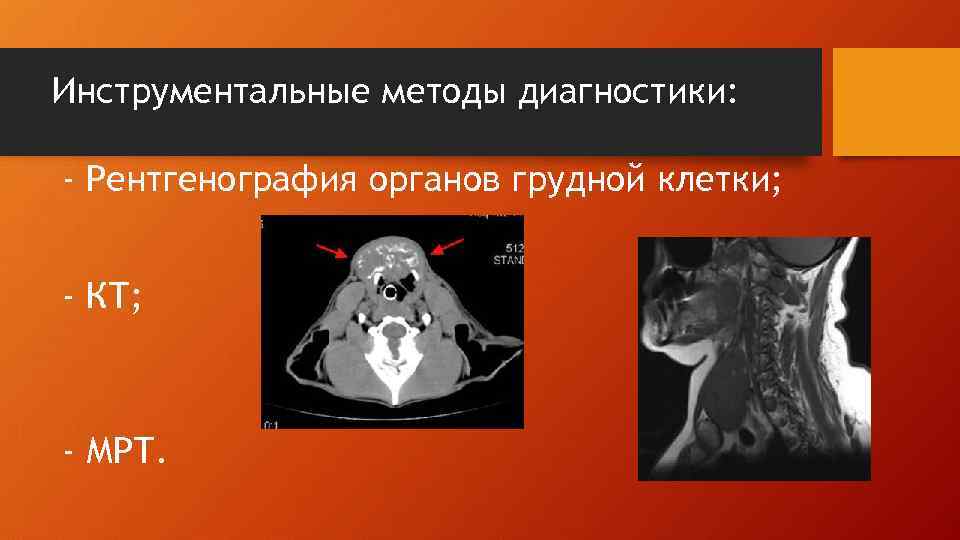 Инструментальные методы диагностики: - Рентгенография органов грудной клетки; - КТ; - МРТ. 