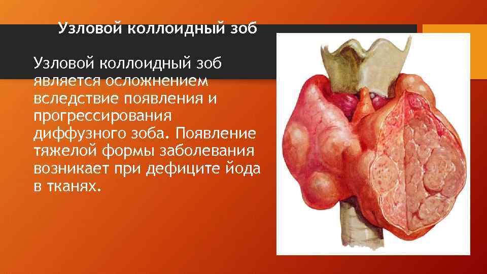 Узловой коллоидный зоб является осложнением вследствие появления и прогрессирования диффузного зоба. Появление тяжелой формы