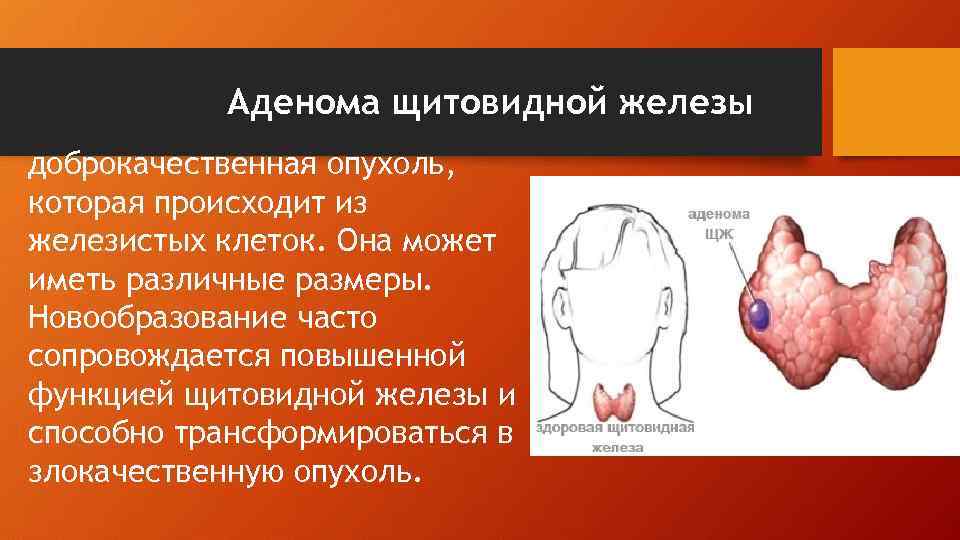 Аденома щитовидной железы доброкачественная опухоль, которая происходит из железистых клеток. Она может иметь различные