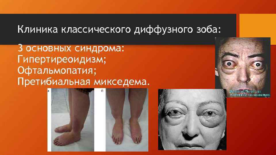 Клиника классического диффузного зоба: 3 основных синдрома: Гипертиреоидизм; Офтальмопатия; Претибиальная микседема. 