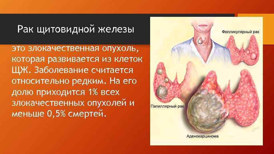 Рак щитовидной железы это злокачественная опухоль, которая развивается из клеток ЩЖ. Заболевание считается относительно