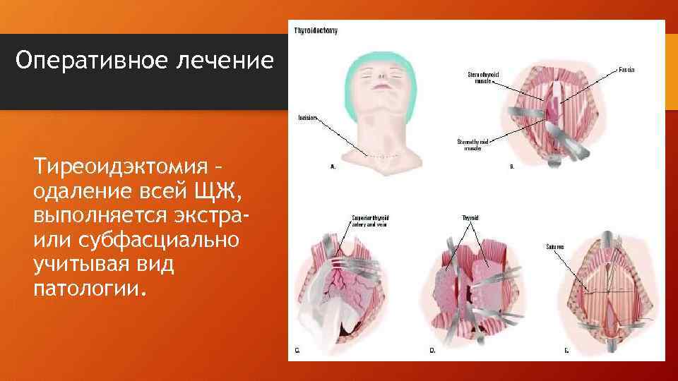 Оперативное лечение Тиреоидэктомия – одаление всей ЩЖ, выполняется экстраили субфасциально учитывая вид патологии. 