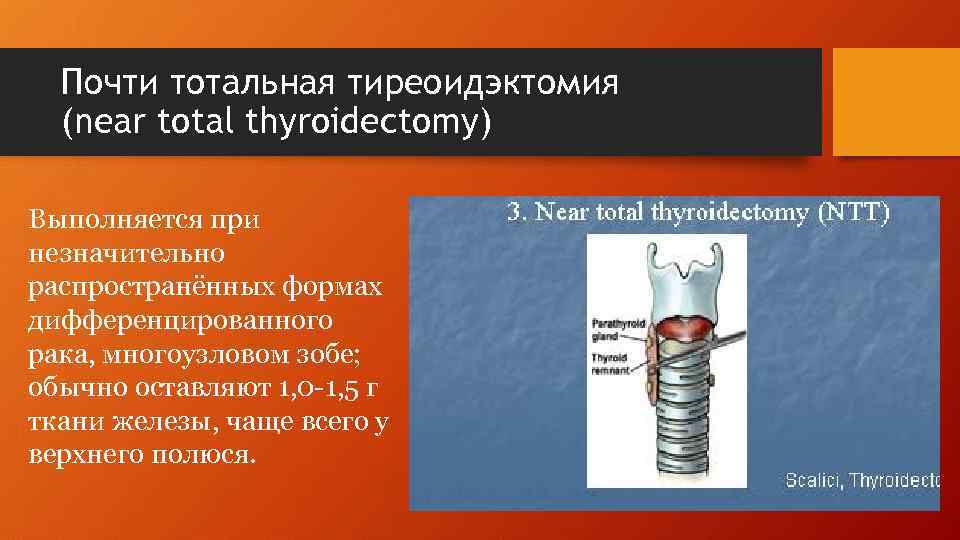 Почти тотальная тиреоидэктомия (near total thyroidectomy) Выполняется при незначительно распространённых формах дифференцированного рака, многоузловом