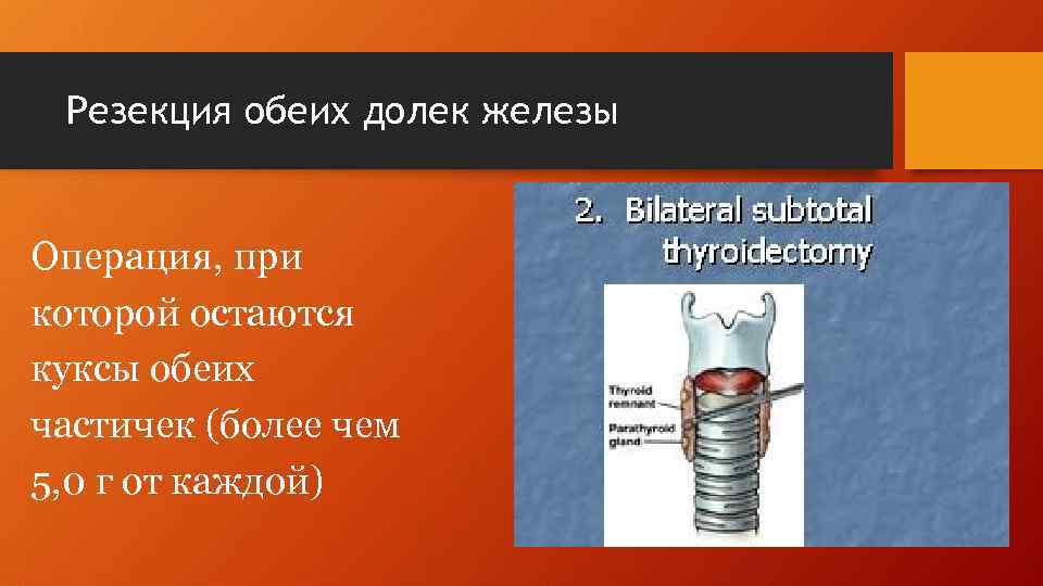 Резекция обеих долек железы Операция, при которой остаются куксы обеих частичек (более чем 5,