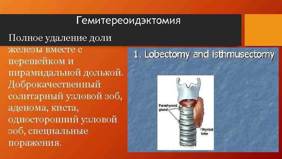 Гемитереоидэктомия Полное удаление доли железы вместе с перешейком и пирамидальной долькой. Доброкачественный солитарный узловой