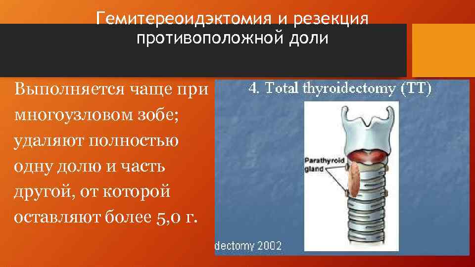 Гемитереоидэктомия и резекция противоположной доли Выполняется чаще при многоузловом зобе; удаляют полностью одну долю
